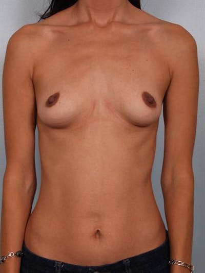 Breast Augmentation Before & After Gallery - Patient 1310317 - Image 1