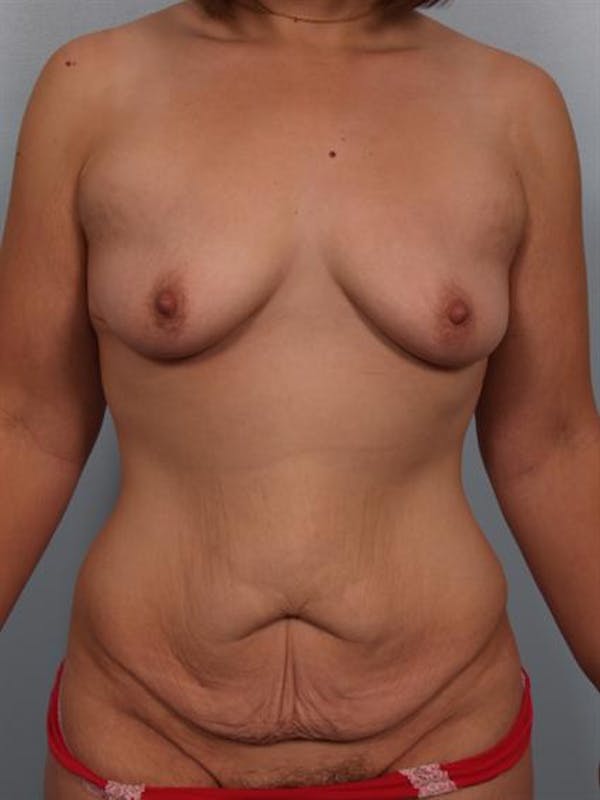 Breast Augmentation Gallery - Patient 1310318 - Image 1