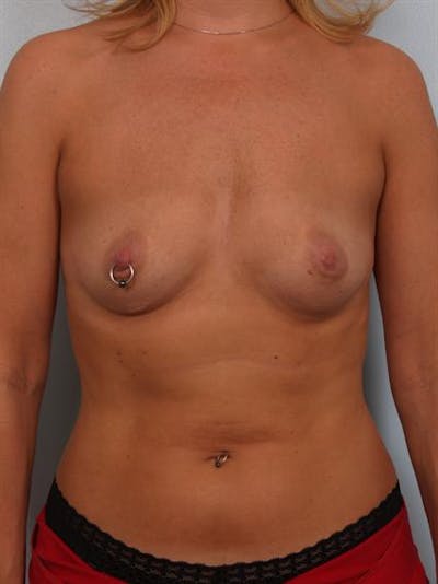 Breast Augmentation Before & After Gallery - Patient 1310356 - Image 1