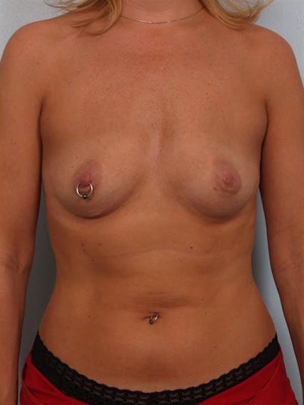 Breast Augmentation Gallery - Patient 1310356 - Image 1