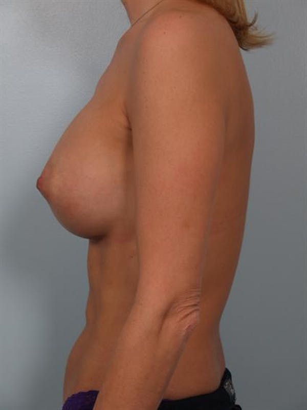 Breast Augmentation Before & After Gallery - Patient 1310356 - Image 4