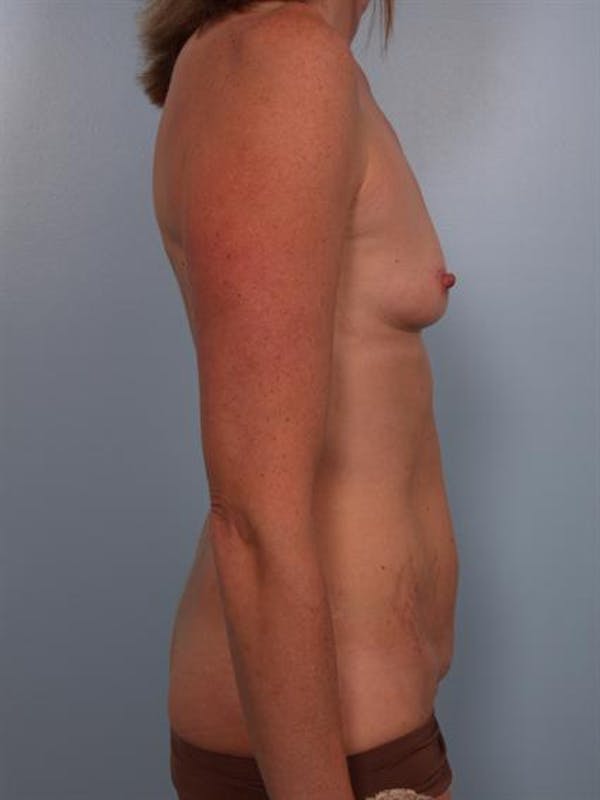Breast Augmentation Before & After Gallery - Patient 1310357 - Image 3