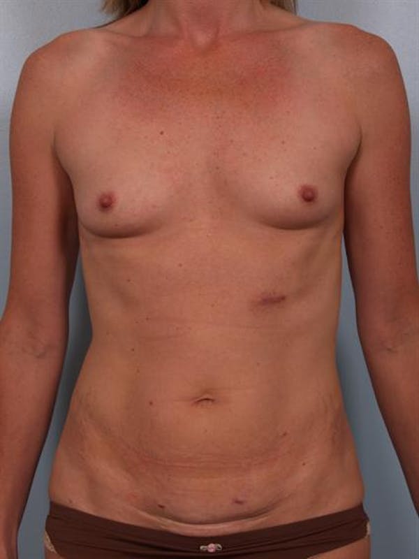Breast Augmentation Gallery - Patient 1310357 - Image 5