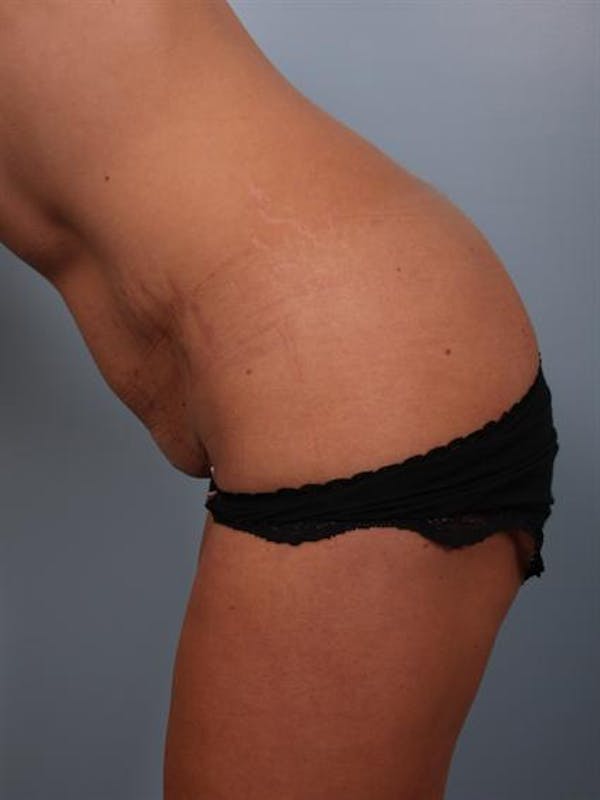 Breast Augmentation Before & After Gallery - Patient 1310357 - Image 7