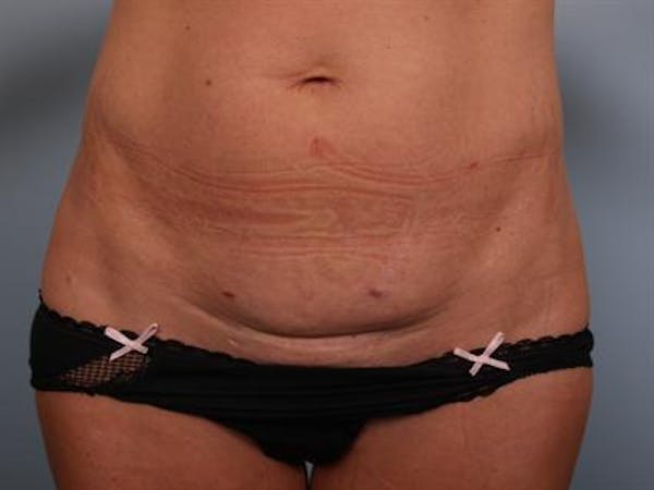 Breast Augmentation Gallery - Patient 1310357 - Image 9