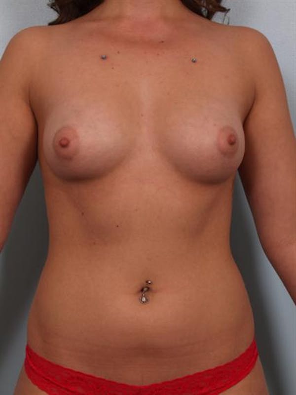 Breast Augmentation Before & After Gallery - Patient 1310358 - Image 1