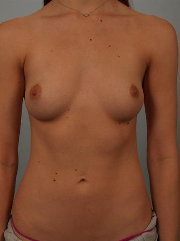 Breast Augmentation Gallery - Patient 1310360 - Image 1