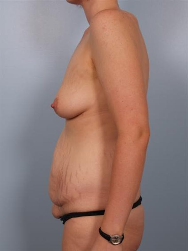 Breast Augmentation Gallery - Patient 1310362 - Image 5