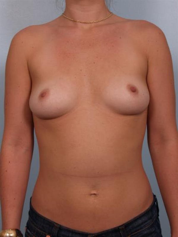 Breast Augmentation Before & After Gallery - Patient 1310363 - Image 3