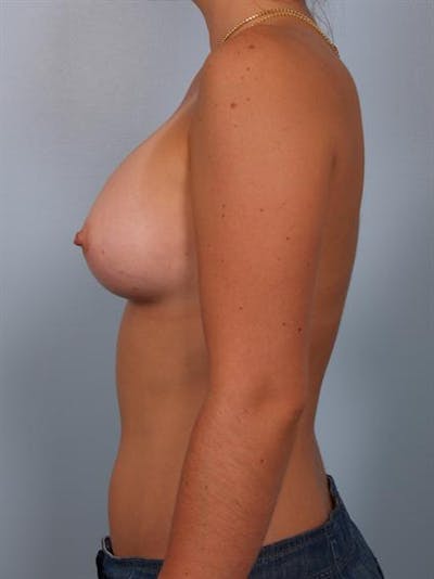 Breast Augmentation Before & After Gallery - Patient 1310363 - Image 6