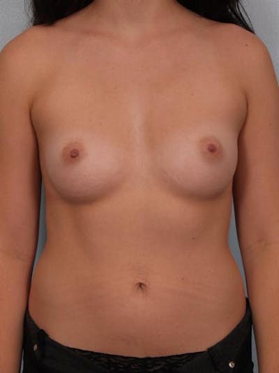 Breast Augmentation Before & After Gallery - Patient 1310364 - Image 1