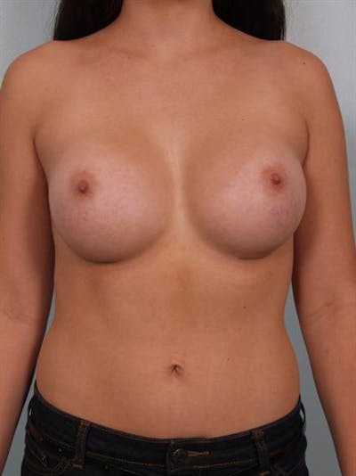 Breast Augmentation Before & After Gallery - Patient 1310364 - Image 2