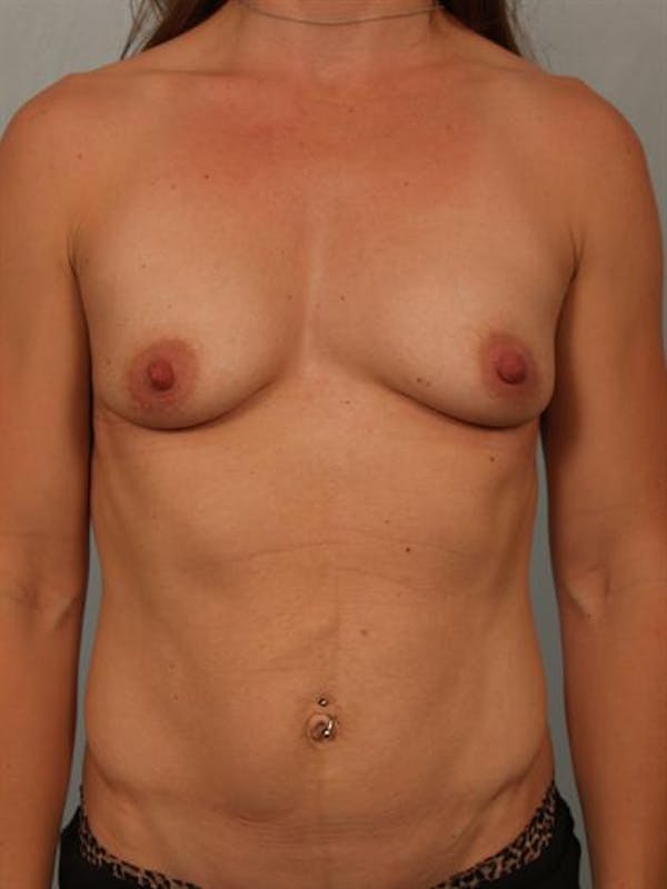 Breast Augmentation Gallery - Patient 1310365 - Image 3