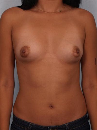 Breast Augmentation Before & After Gallery - Patient 1310366 - Image 1