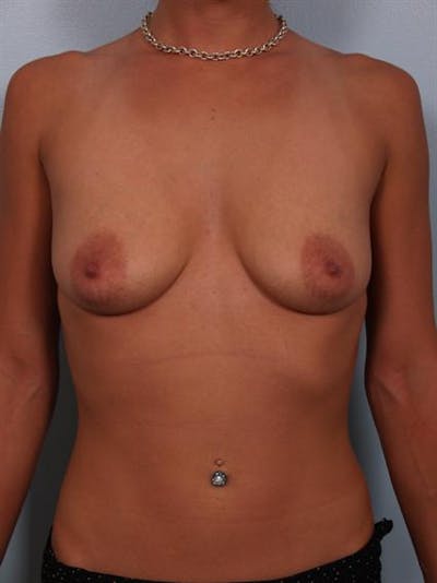 Breast Augmentation Before & After Gallery - Patient 1310367 - Image 1