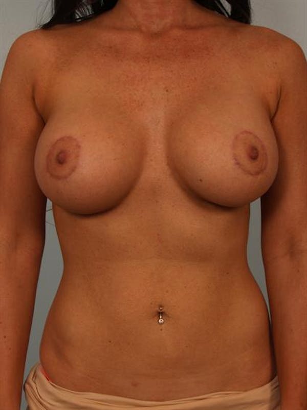 Breast Augmentation Before & After Gallery - Patient 1310368 - Image 2
