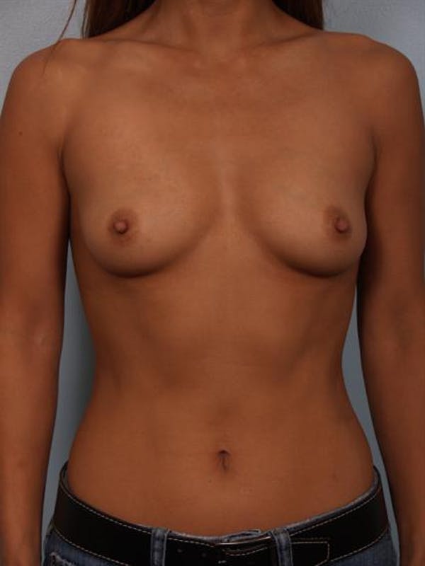 Breast Augmentation Before & After Gallery - Patient 1310370 - Image 3