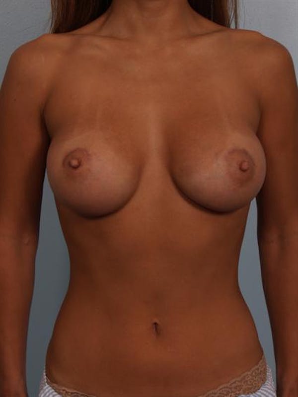 Breast Augmentation Before & After Gallery - Patient 1310370 - Image 4