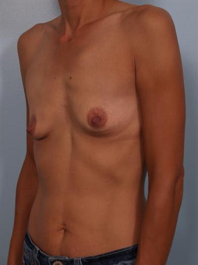Breast Augmentation Before & After Gallery - Patient 1310371 - Image 1