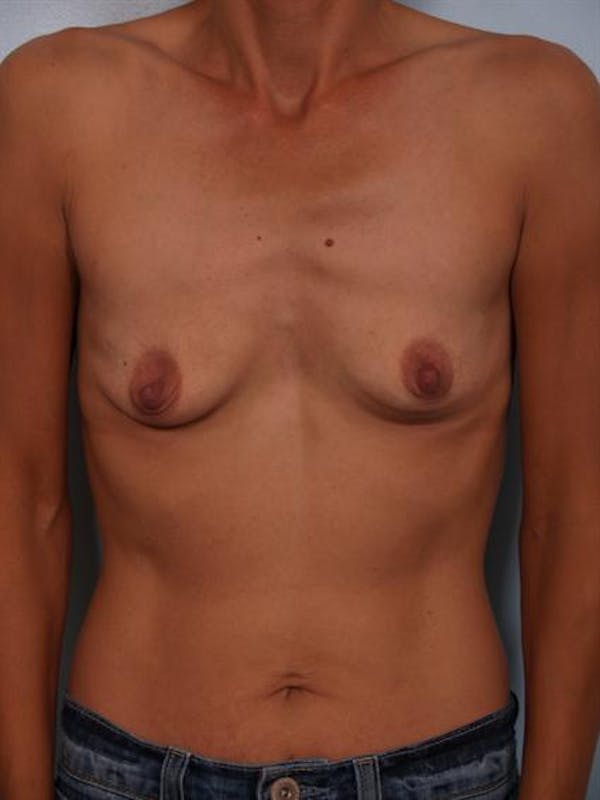 Breast Augmentation Before & After Gallery - Patient 1310371 - Image 3