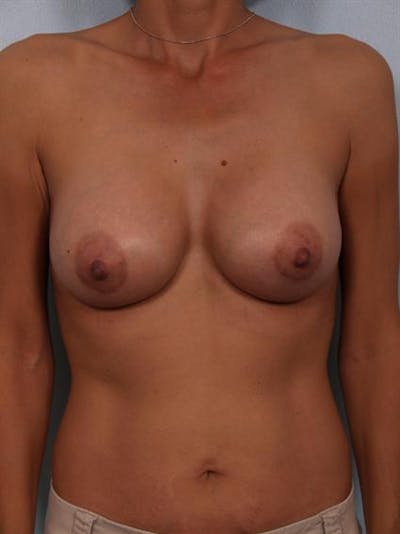 Breast Augmentation Before & After Gallery - Patient 1310371 - Image 4