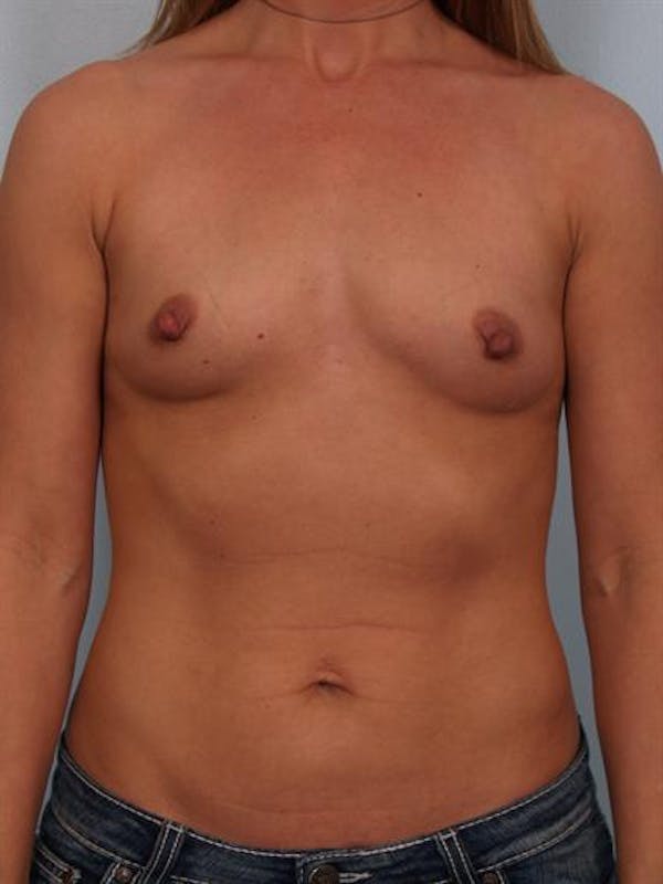Breast Augmentation Gallery - Patient 1310373 - Image 1