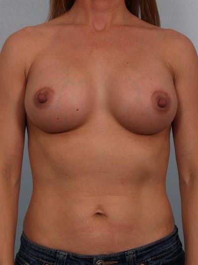 Breast Augmentation Before & After Gallery - Patient 1310373 - Image 2