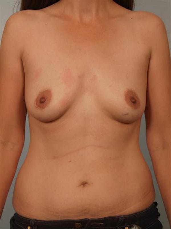 Breast Augmentation Before & After Gallery - Patient 1310374 - Image 1