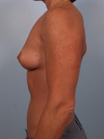 Breast Augmentation Before & After Gallery - Patient 1310376 - Image 1