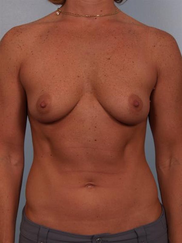 Breast Augmentation Gallery - Patient 1310376 - Image 3
