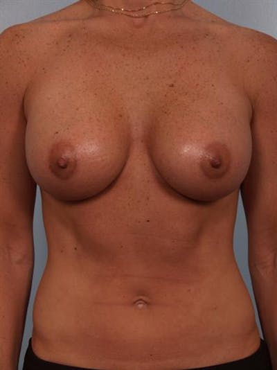 Breast Augmentation Before & After Gallery - Patient 1310376 - Image 4