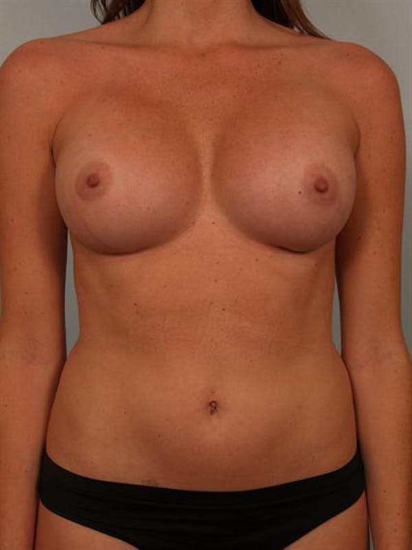 Breast Augmentation Gallery - Patient 1310377 - Image 2