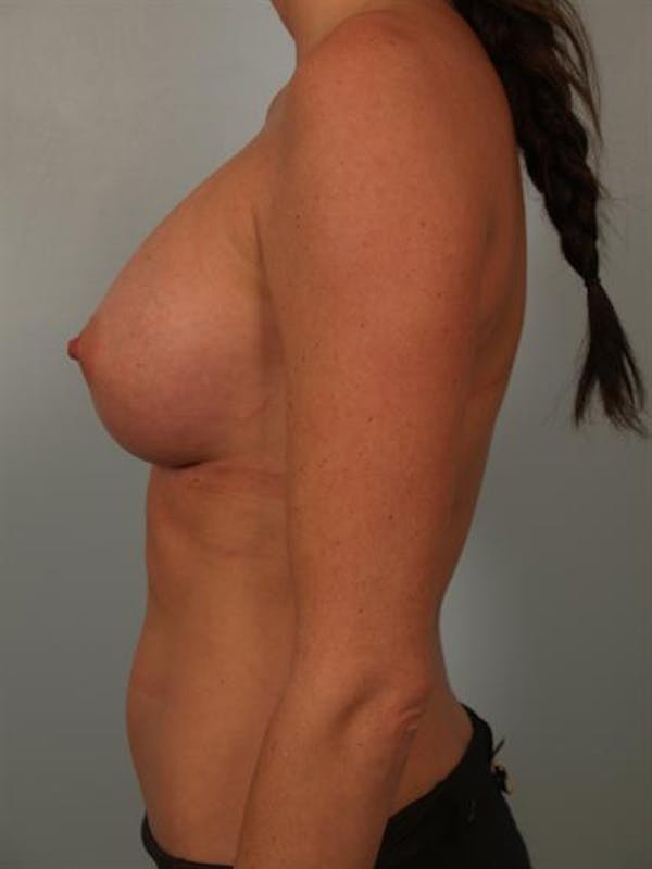 Breast Augmentation Before & After Gallery - Patient 1310377 - Image 6