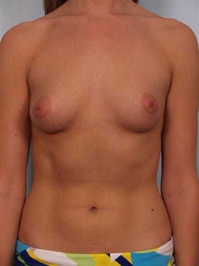 Breast Augmentation Before & After Gallery - Patient 1310378 - Image 1