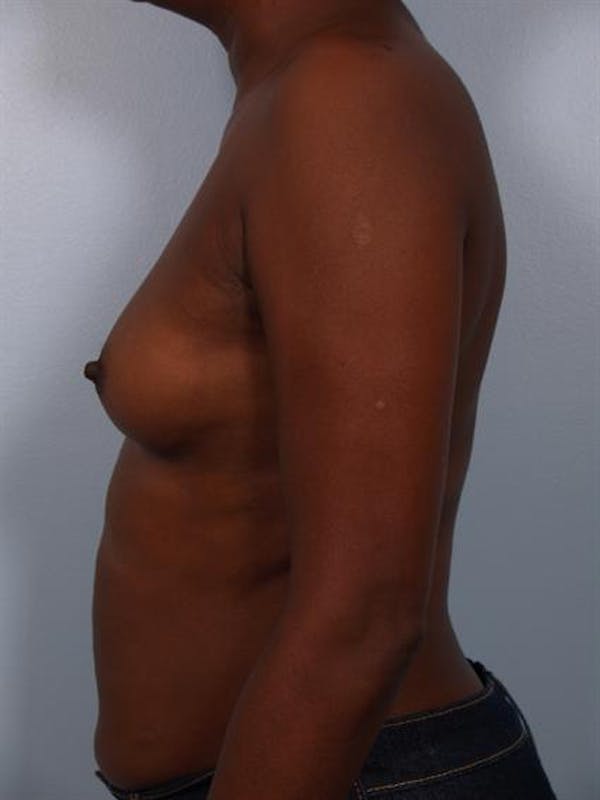 Breast Augmentation Before & After Gallery - Patient 1310379 - Image 1