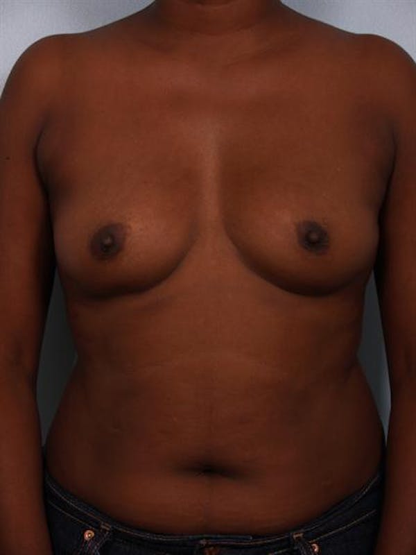 Breast Augmentation Gallery - Patient 1310379 - Image 3