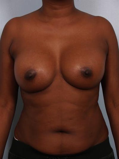 Breast Augmentation Gallery - Patient 1310379 - Image 4