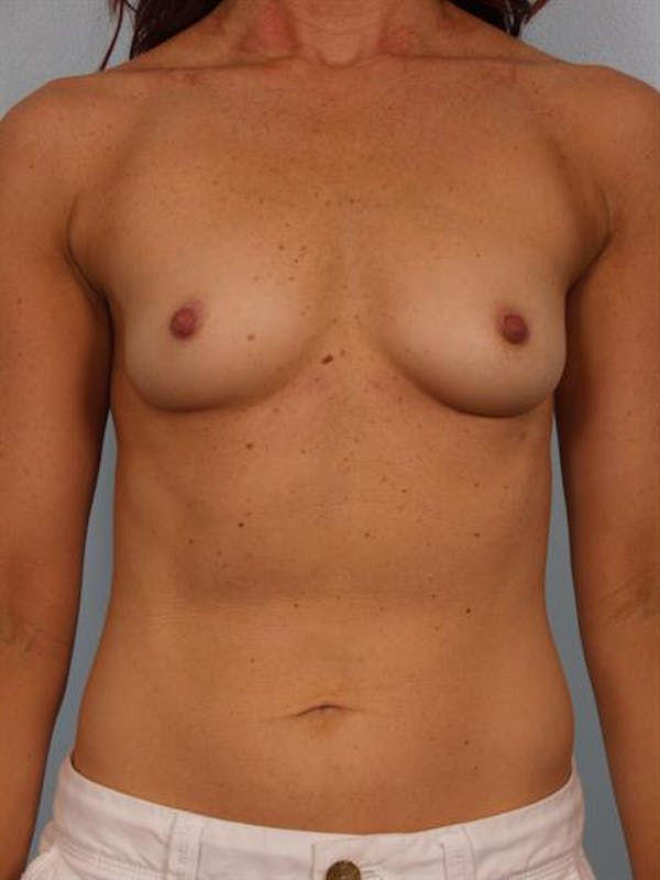 Breast Augmentation Before & After Gallery - Patient 1310380 - Image 1