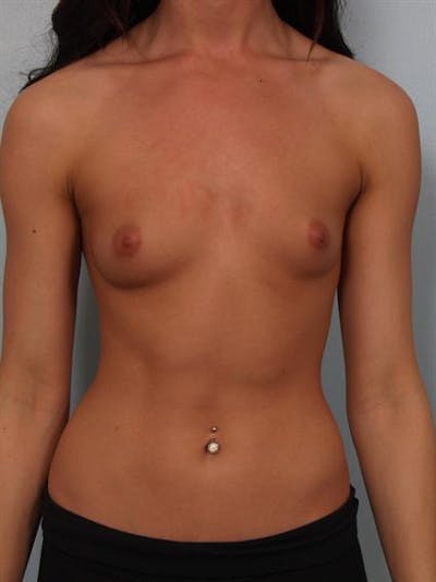 Breast Augmentation Before & After Gallery - Patient 1310381 - Image 1