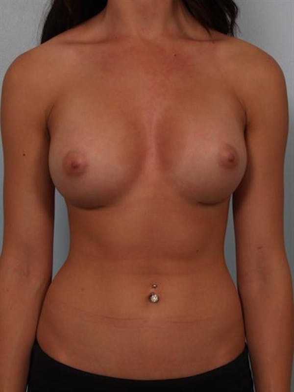 Breast Augmentation Gallery - Patient 1310381 - Image 2