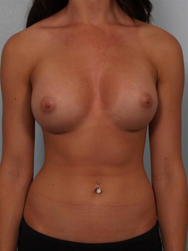 Breast Augmentation Before & After Gallery - Patient 1310381 - Image 2