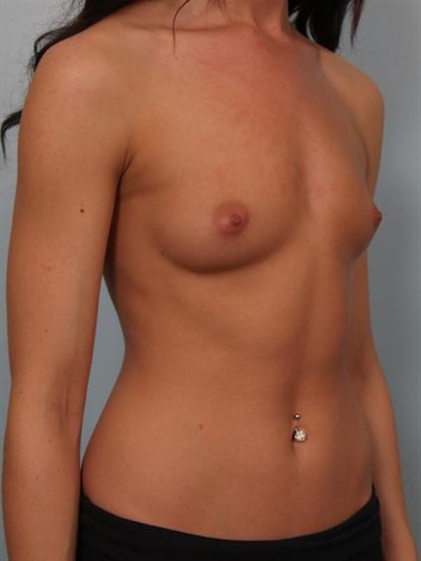 Breast Augmentation Before & After Gallery - Patient 1310381 - Image 5