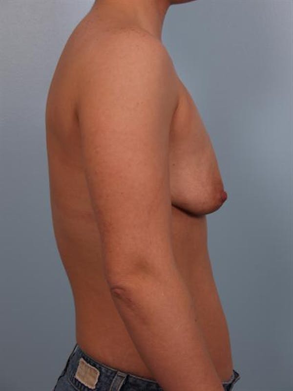 Breast Augmentation Before & After Gallery - Patient 1310382 - Image 5