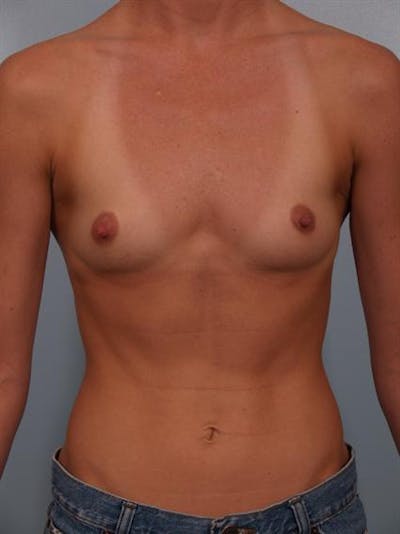 Breast Augmentation Before & After Gallery - Patient 1310383 - Image 1