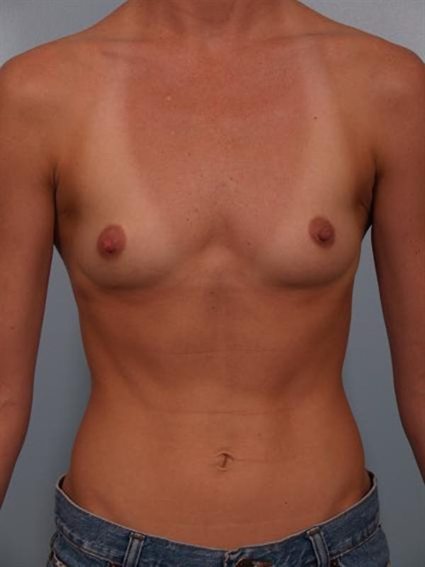 Breast Augmentation Before & After Gallery - Patient 1310383 - Image 1