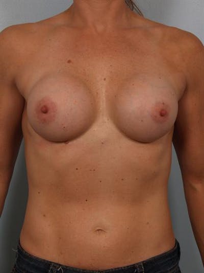 Breast Augmentation Before & After Gallery - Patient 1310398 - Image 1