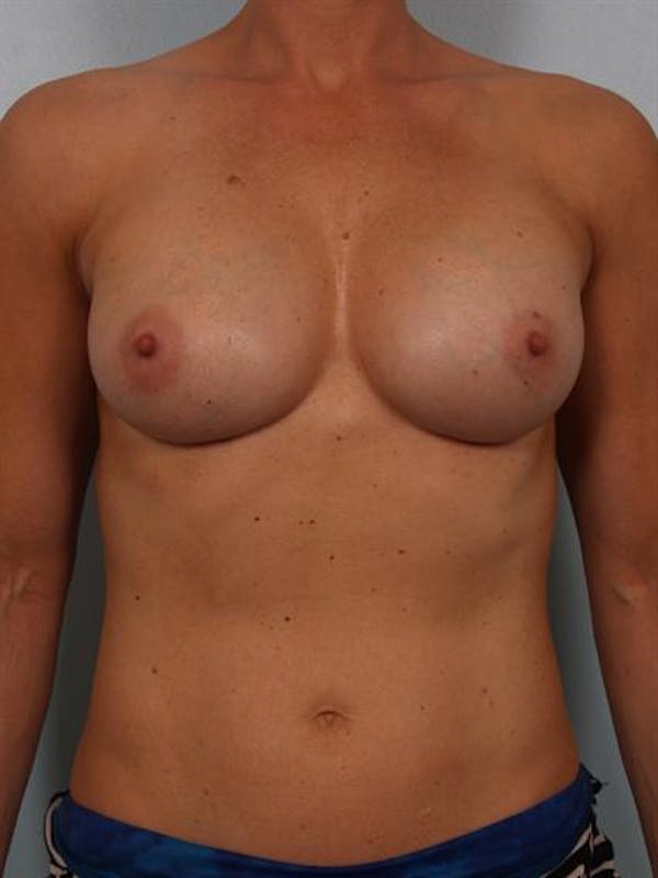 Breast Augmentation Before & After Gallery - Patient 1310398 - Image 2