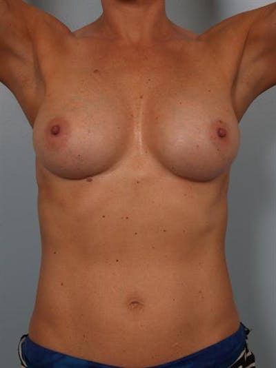 Breast Augmentation Before & After Gallery - Patient 1310398 - Image 6