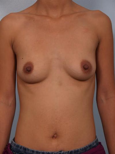 Breast Augmentation Before & After Gallery - Patient 1310400 - Image 1