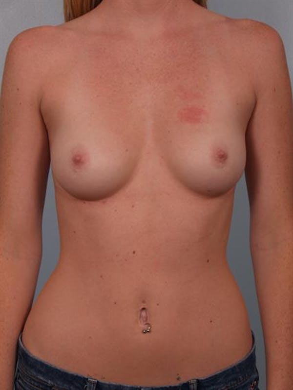 Breast Augmentation Before & After Gallery - Patient 1310401 - Image 1